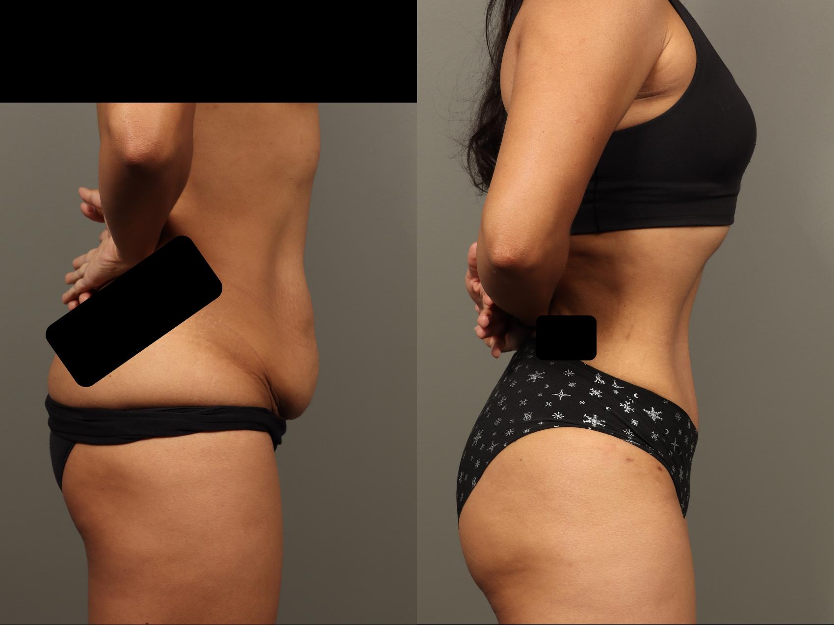 Before & After Abdominoplasty (Tummy Tuck) Case 499 Right Side View in Gilbert, AZ