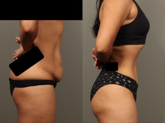 Before & After Abdominoplasty (Tummy Tuck) Case 499 Right Side View in Gilbert, AZ