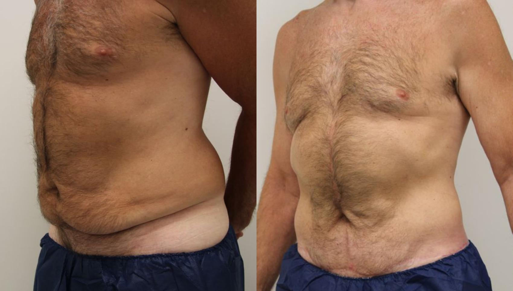 Before & After Body Lift Case 25 View #2 View in Gilbert, AZ