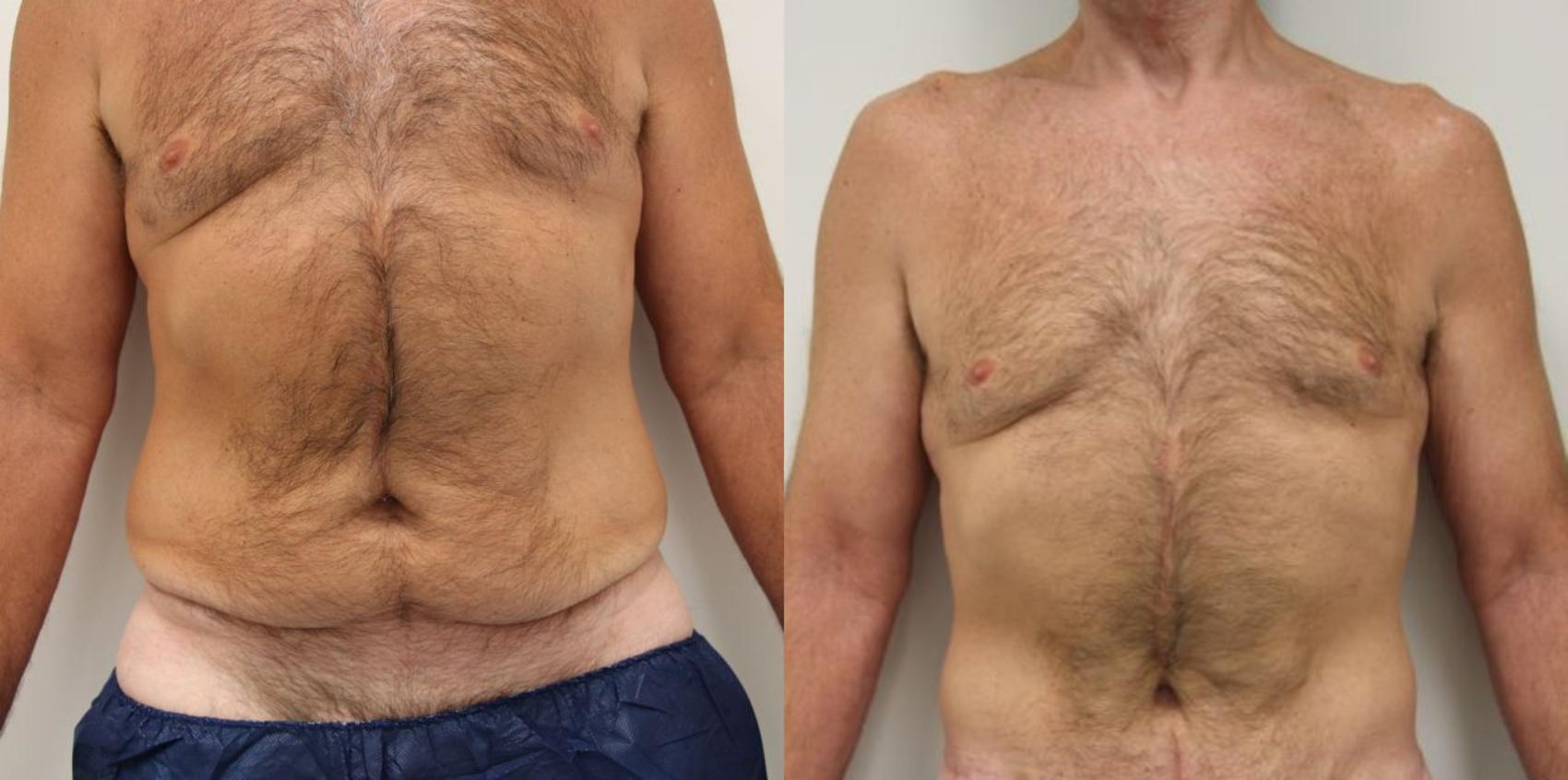 Before & After Body Lift Case 25 View #3 View in Gilbert, AZ