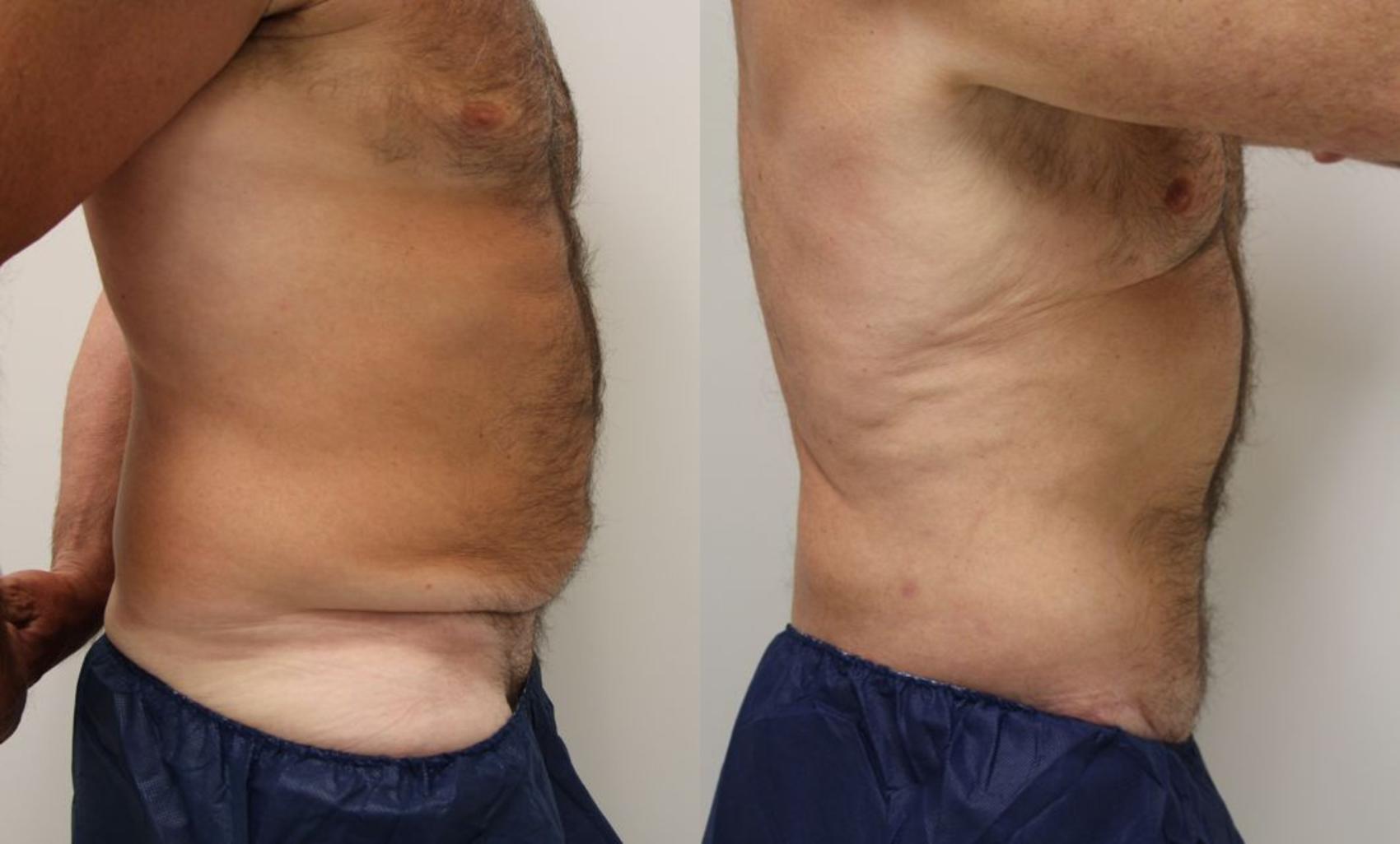 Before & After Body Lift Case 25 View #4 View in Gilbert, AZ