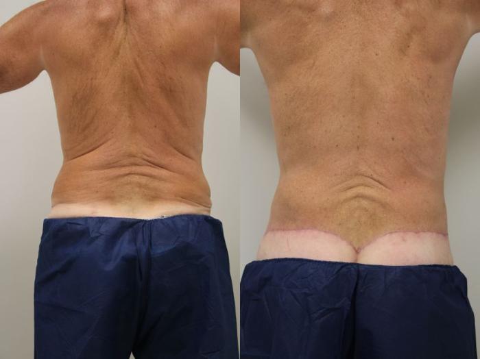 Before & After Body Lift Case 25 View #5 View in Gilbert, AZ