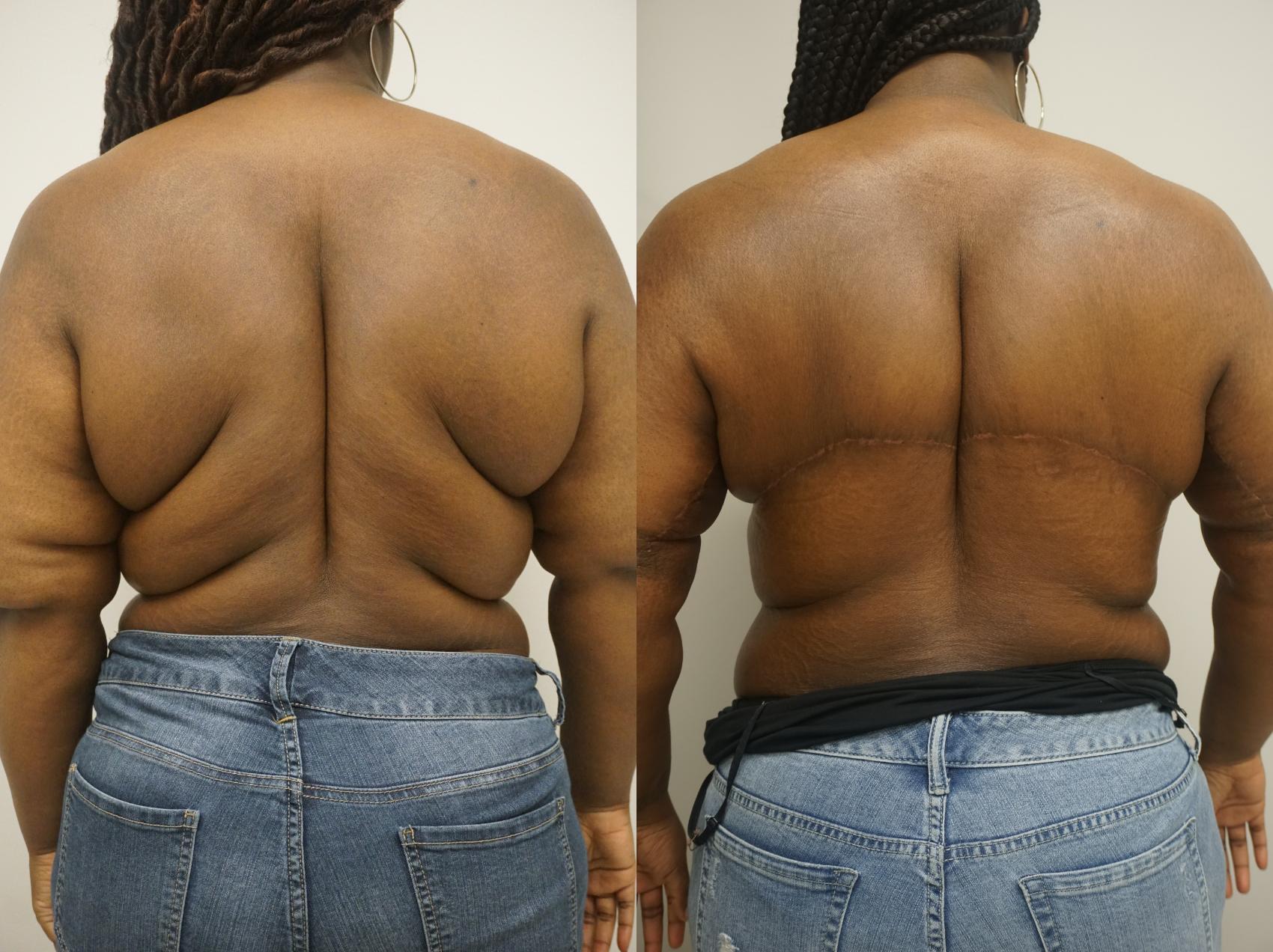 Before & After Body Lift Case 331 Back View in Gilbert, AZ