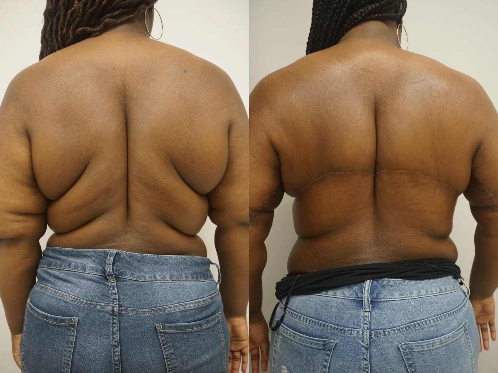 Body Lift Before and After Pictures Case 331, Gilbert, AZ