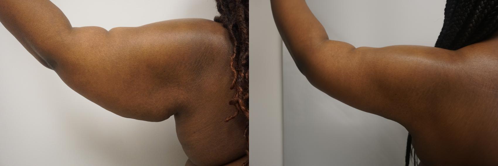 Before & After Body Lift Case 331 Left Side View in Gilbert, AZ