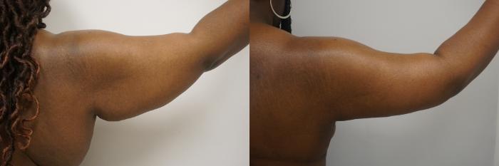 Before & After Brachioplasty Case 331 Right Side View in Gilbert, AZ