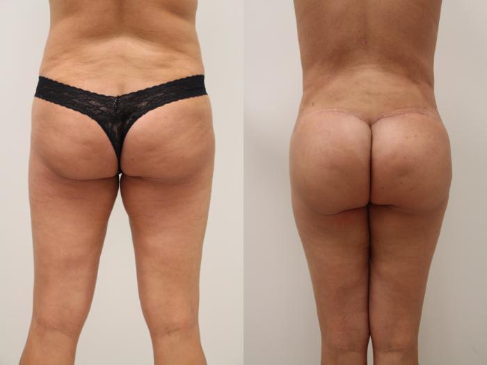 Body Lift Before and After Pictures Case 1003, Los Angeles, CA