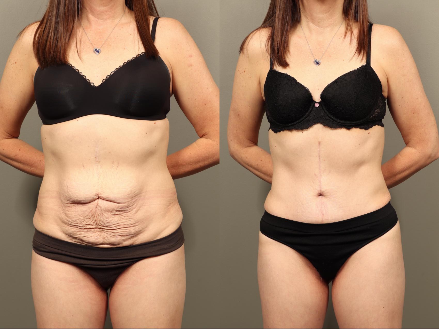 Before & After Body Lift Case 505 Front View in Gilbert, AZ