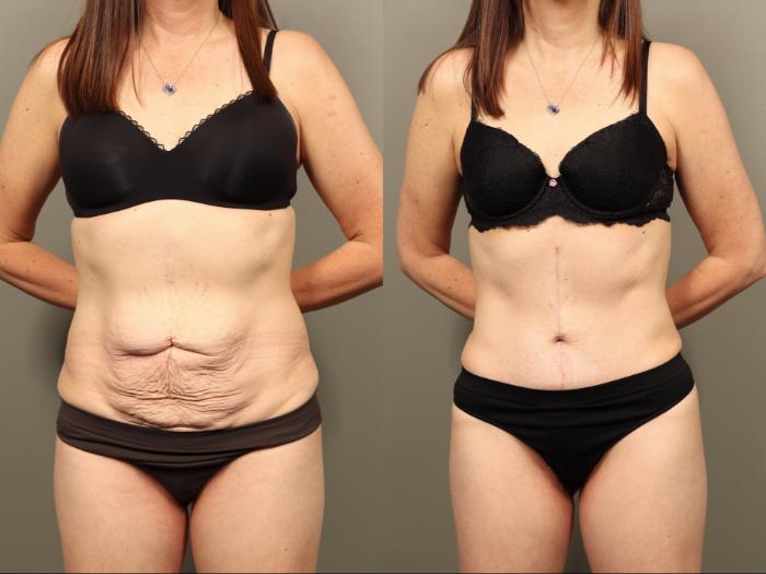 Before & After Body Lift Case 505 Front View in Gilbert, AZ