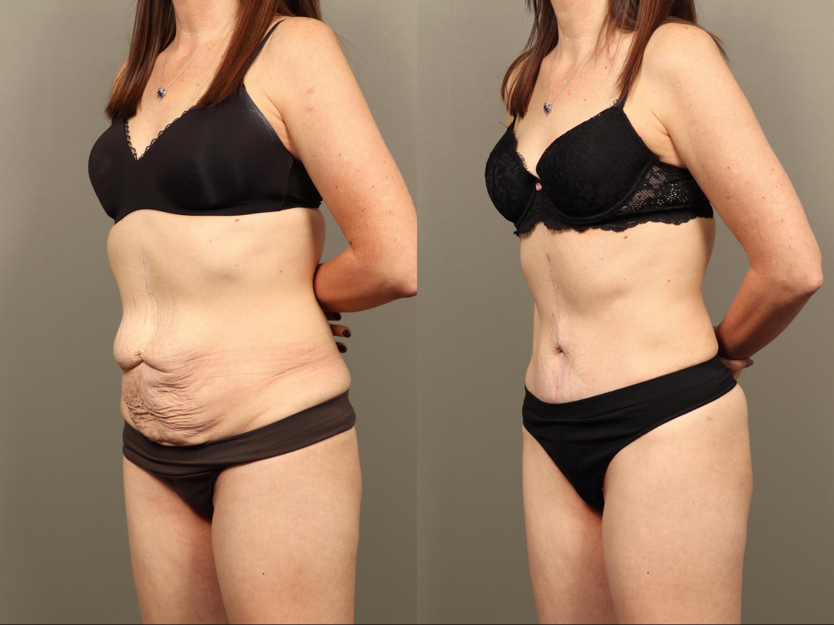 Before & After Body Lift Case 505 Left Oblique View in Gilbert, AZ