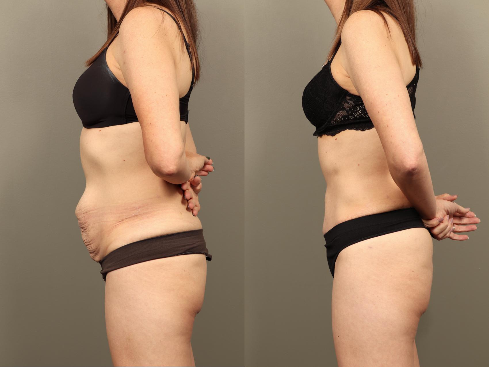 Before & After Body Lift Case 505 Left Side View in Gilbert, AZ