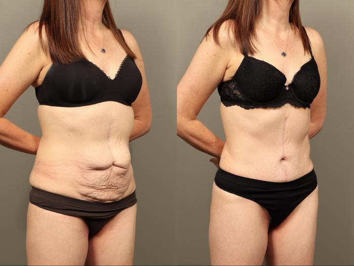 Before & After Body Lift Case 505 Right Oblique View in Gilbert, AZ