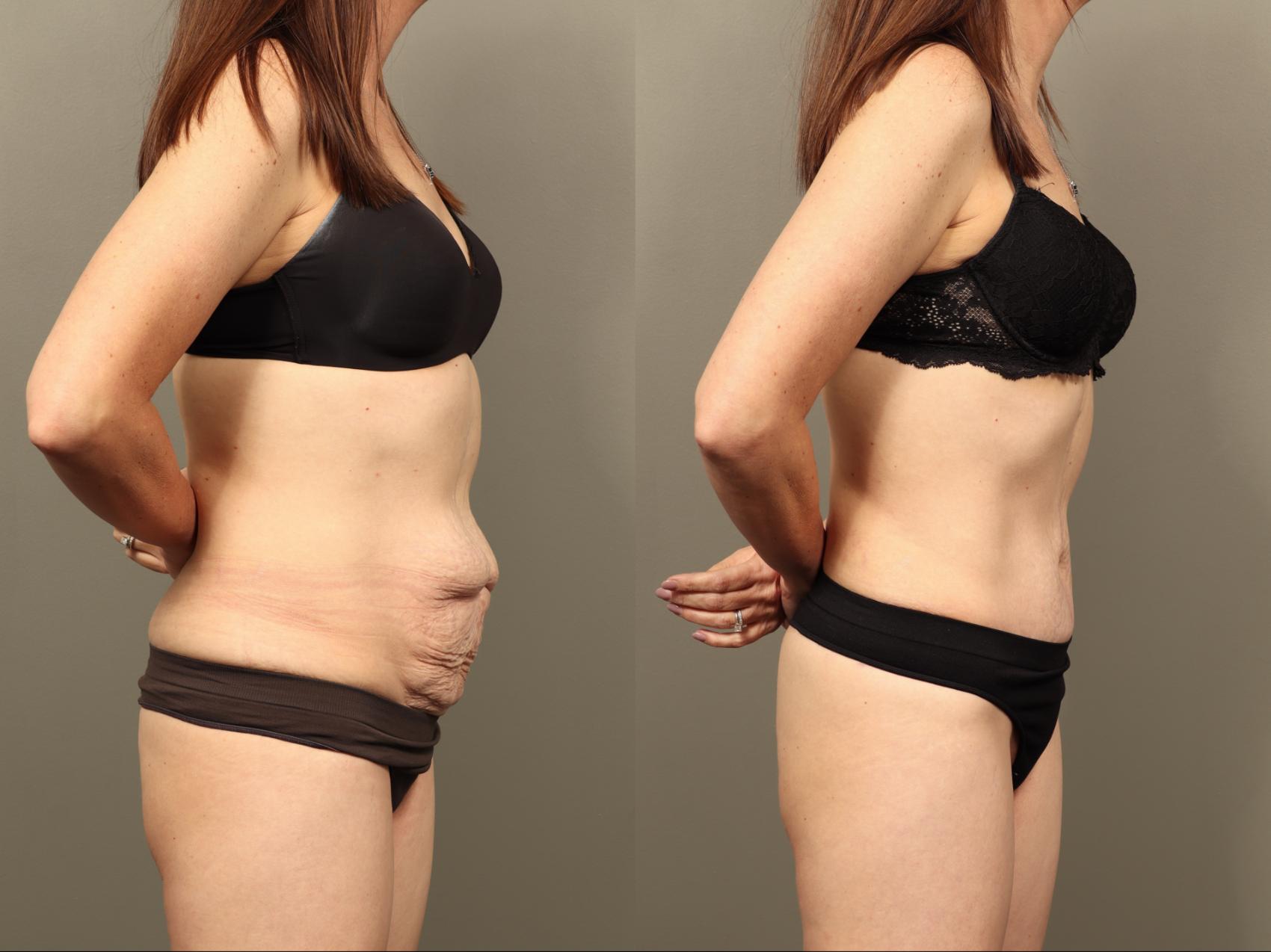 Before & After Body Lift Case 505 Right Side View in Gilbert, AZ