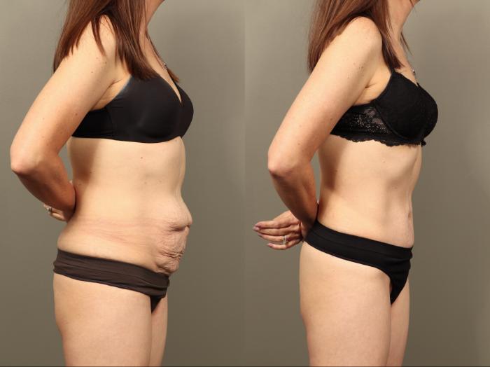 Before & After Body Lift Case 505 Right Side View in Gilbert, AZ