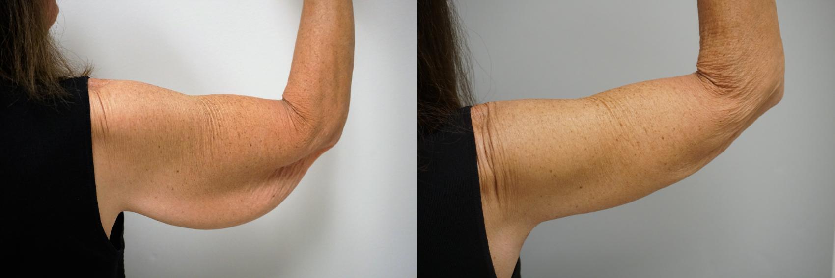 Before & After Brachioplasty Case 105 View #2 View in Gilbert, AZ