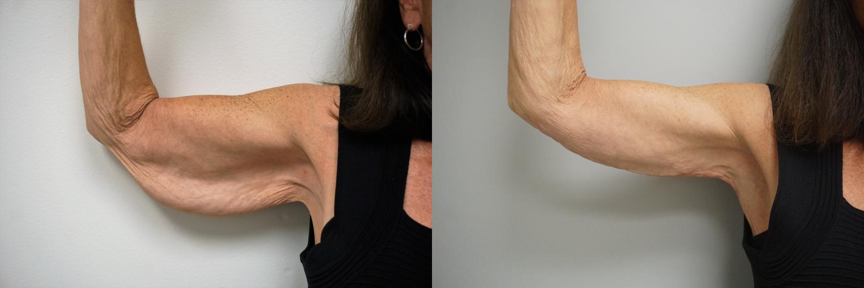 Before & After Brachioplasty Case 105 View #3 View in Gilbert, AZ