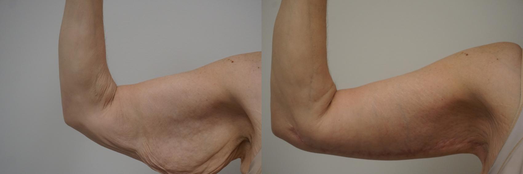New Kao Plastic Surgery Innovation - Arm Lift - Circumaxillary Brachioplasty  - Tightens Skin On Arms - YouTube