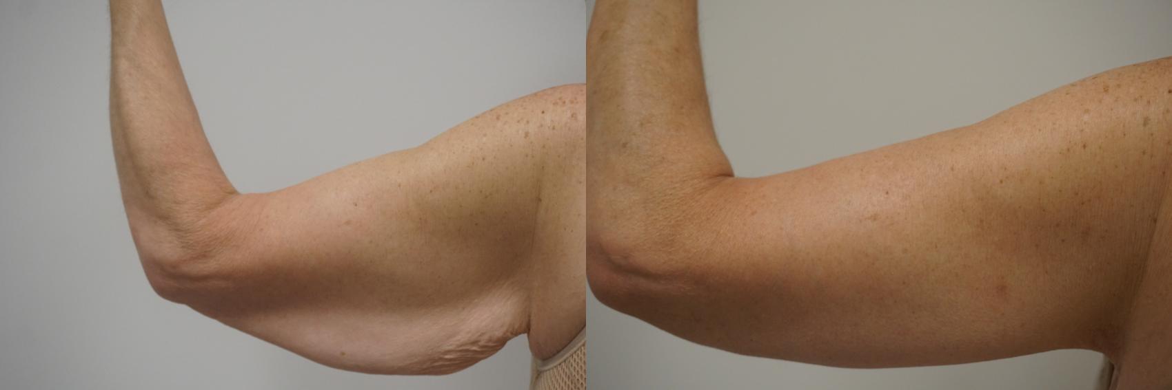 Before & After Brachioplasty Case 115 View #2 View in Gilbert, AZ