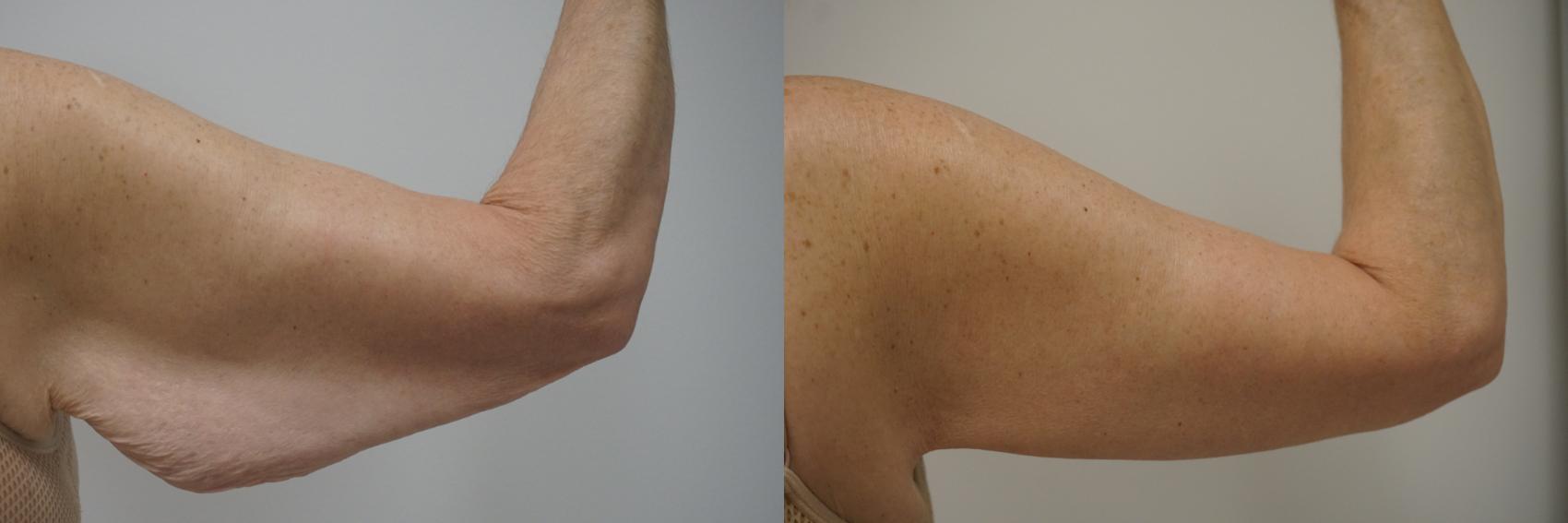 Before & After Brachioplasty Case 115 View #3 View in Gilbert, AZ