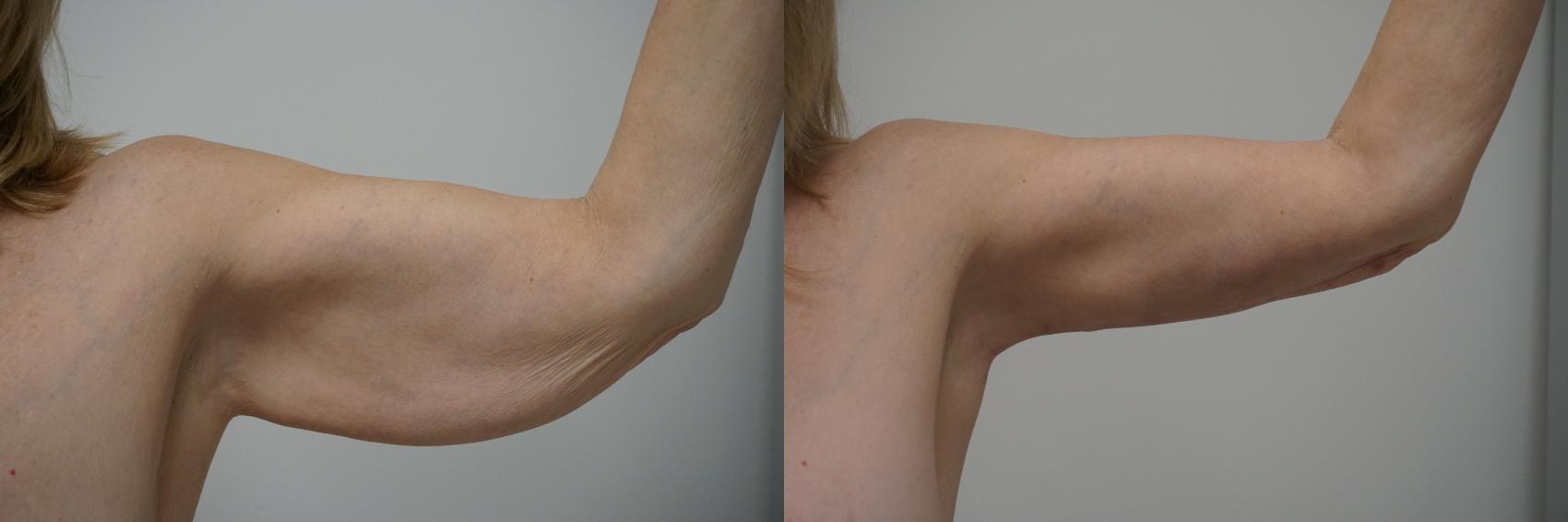 Before & After Brachioplasty Case 117 View #3 View in Gilbert, AZ