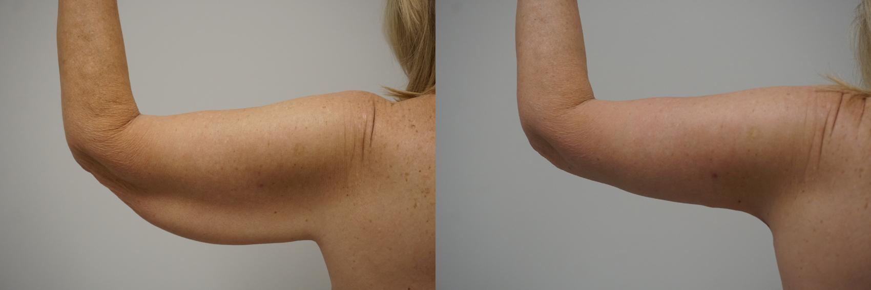 Before & After Brachioplasty Case 117 View #4 View in Gilbert, AZ