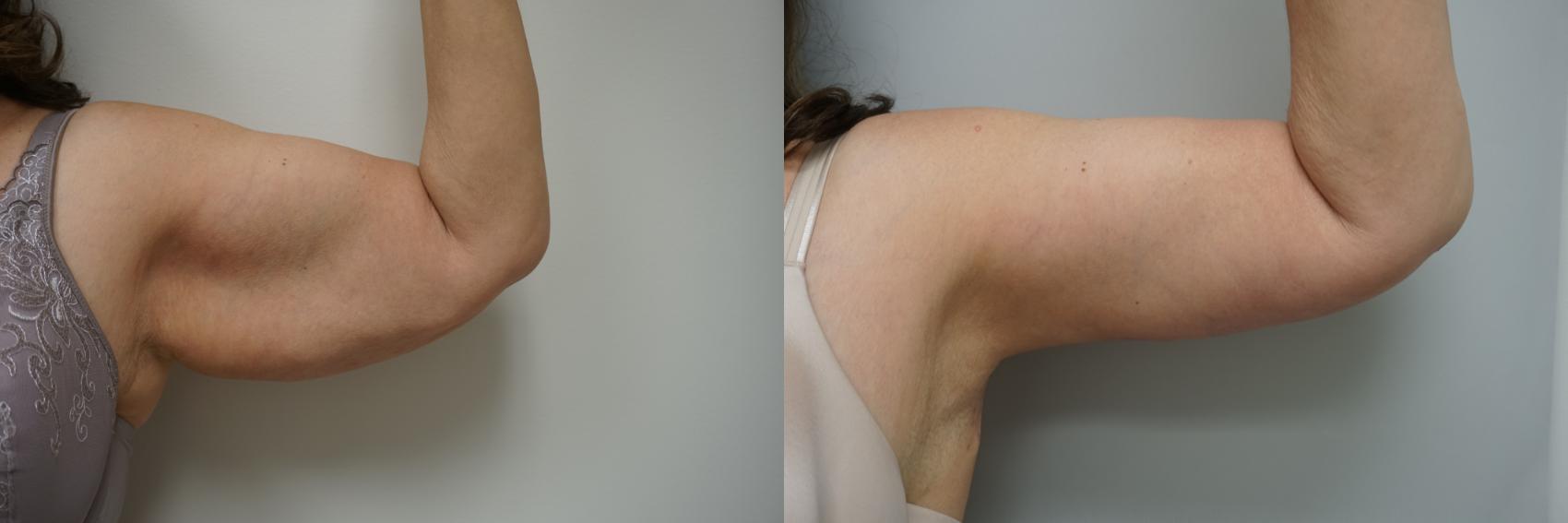 Before & After Brachioplasty Case 171 View #2 View in Gilbert, AZ