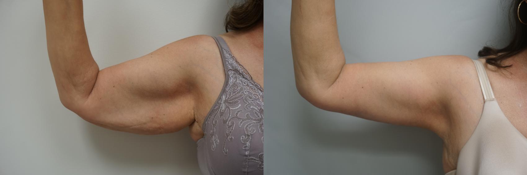 Before & After Brachioplasty Case 171 View #3 View in Gilbert, AZ