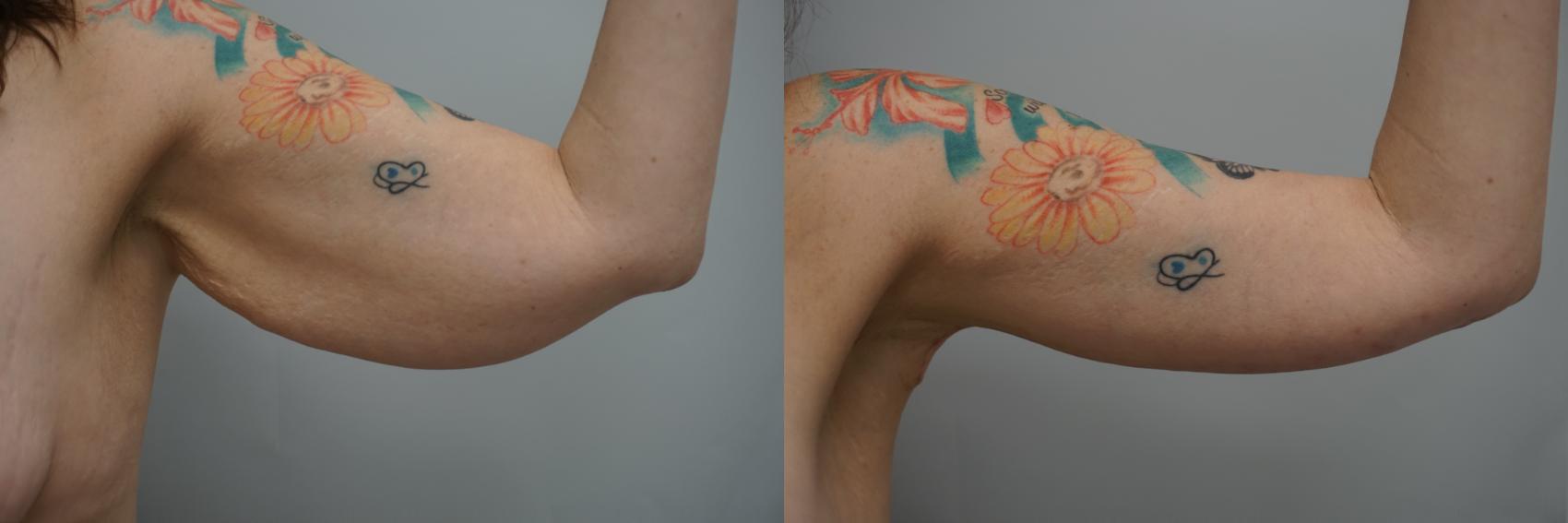 Before & After Brachioplasty Case 198 View #2 View in Gilbert, AZ