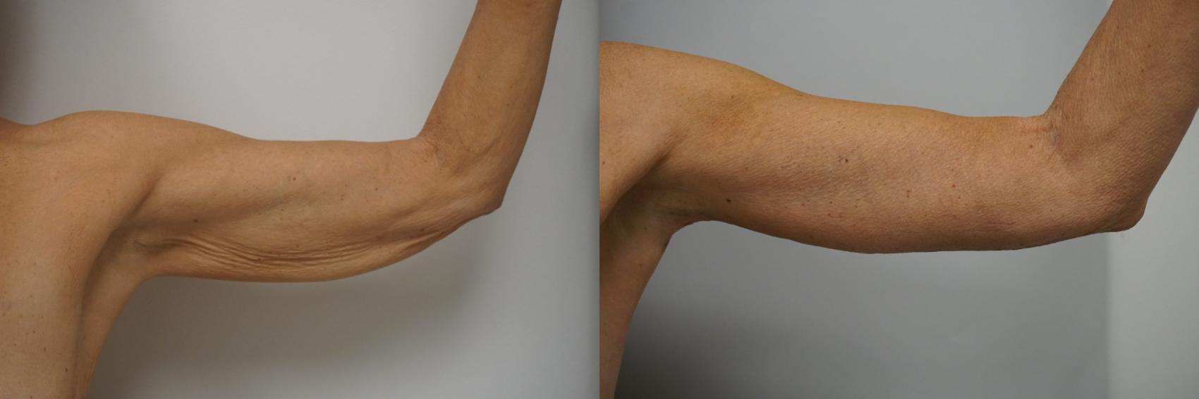 Before & After Brachioplasty Case 235 View #2 View in Gilbert, AZ