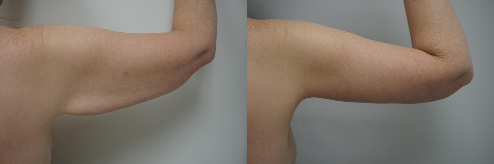 Before & After Brachioplasty Case 241 View #2 View in Gilbert, AZ