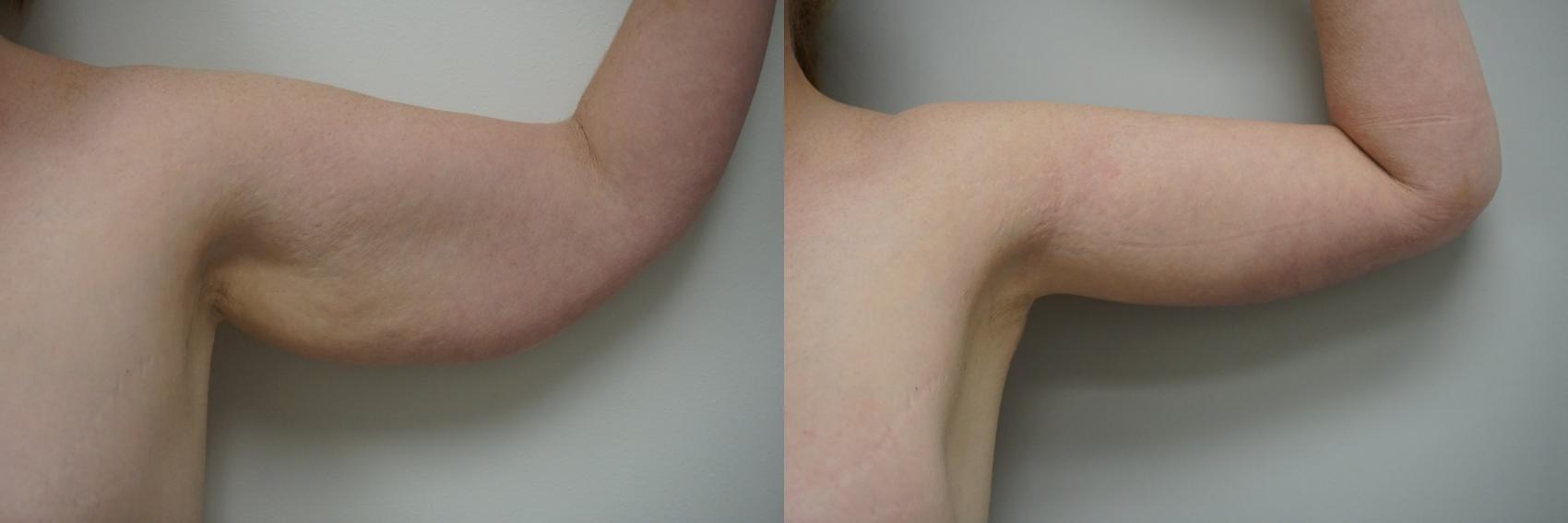 Before & After Brachioplasty Case 241 View #3 View in Gilbert, AZ