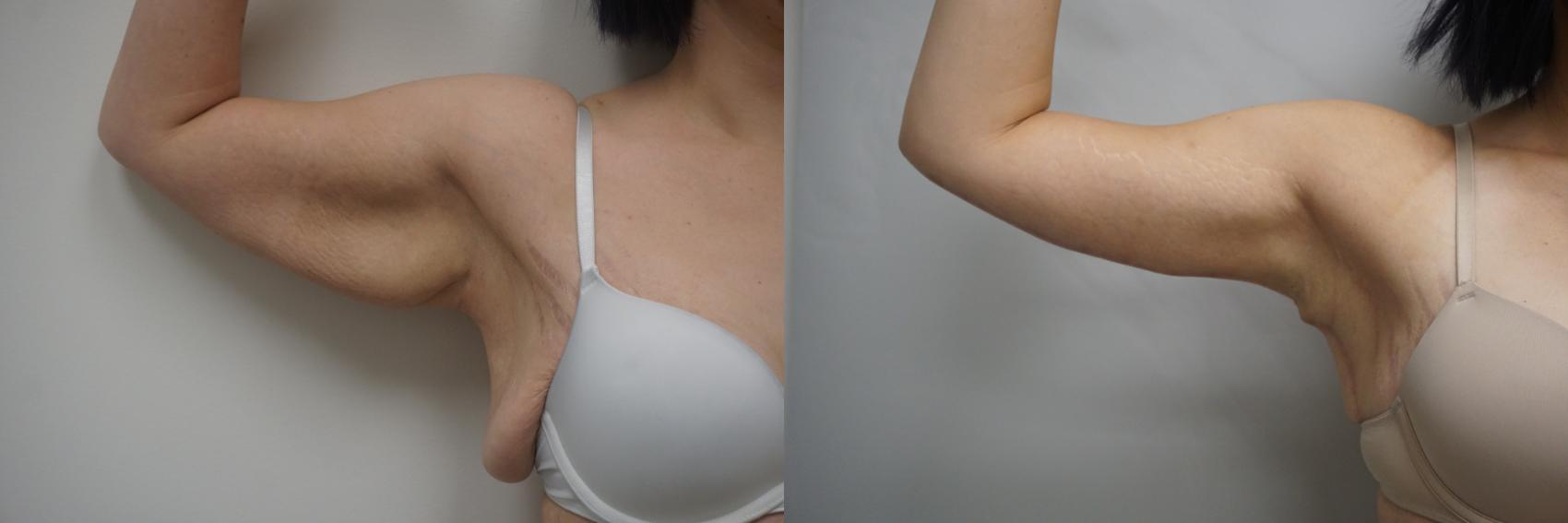 Before & After Brachioplasty Case 274 View #2 View in Gilbert, AZ