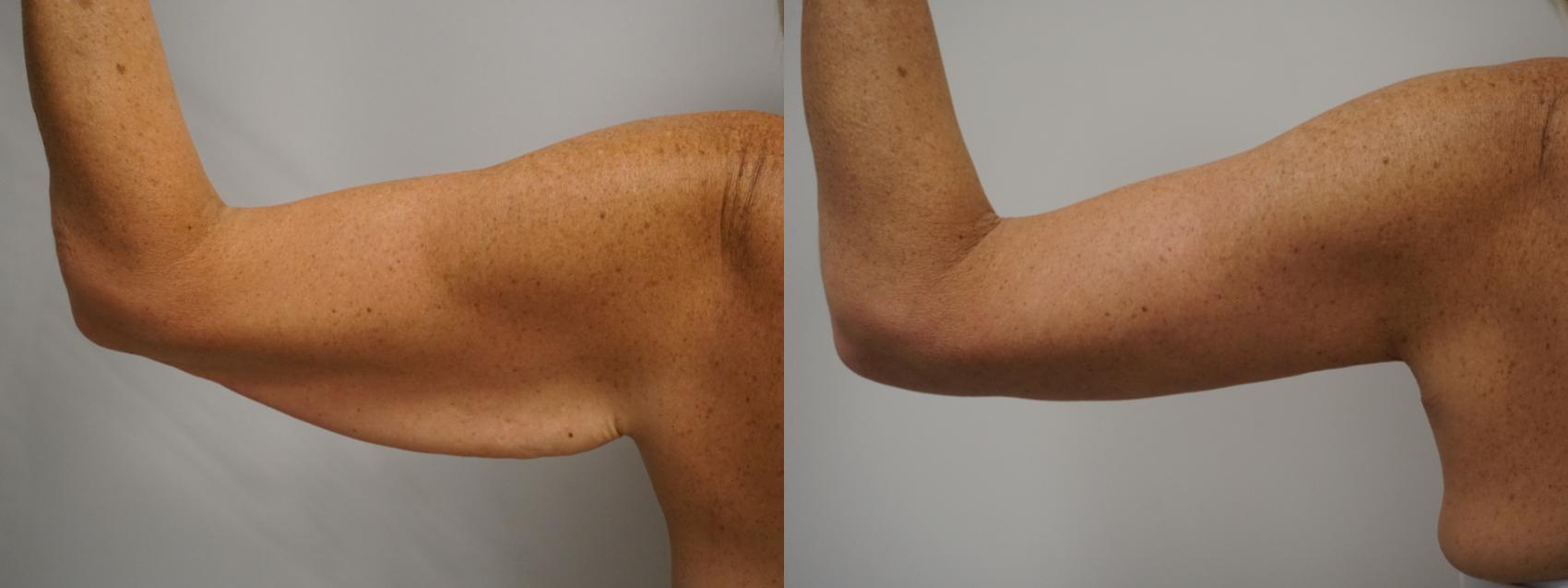 Before & After Brachioplasty Case 282 Back View in Gilbert, AZ