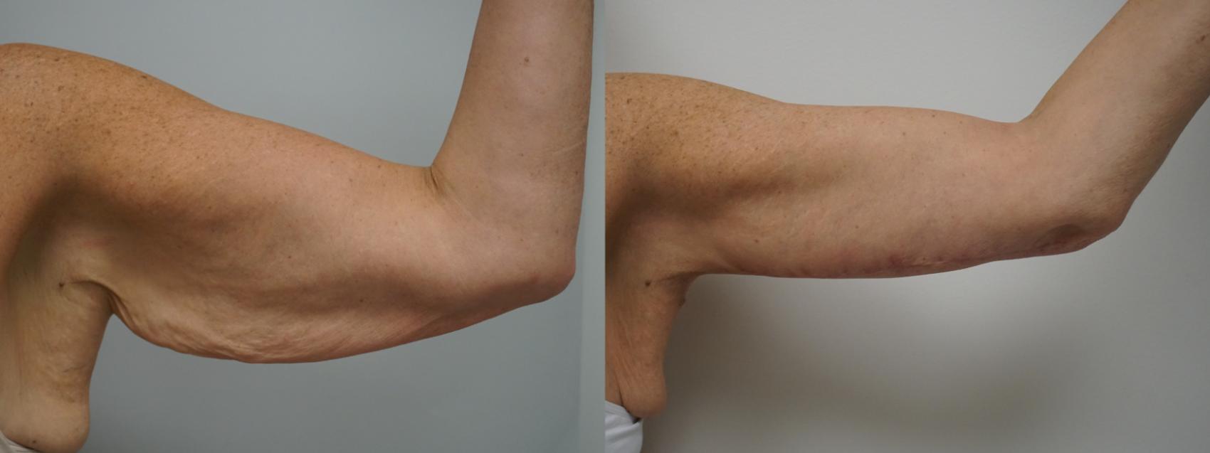 Before & After Brachioplasty Case 282 Left Side View in Gilbert, AZ