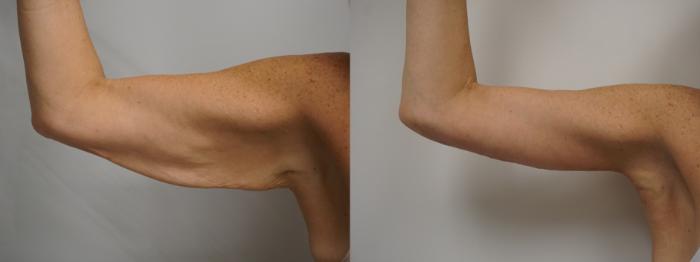 Before & After Brachioplasty Case 282 Right Side View in Gilbert, AZ