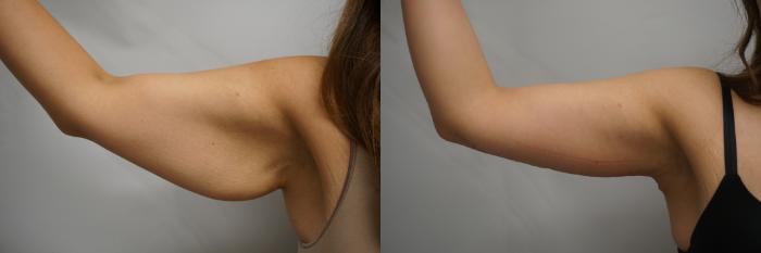 Before & After Brachioplasty Case 333 Right Side View in Gilbert, AZ