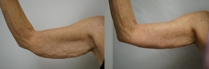 Before & After Brachioplasty Case 387 Left Side View in Gilbert, AZ