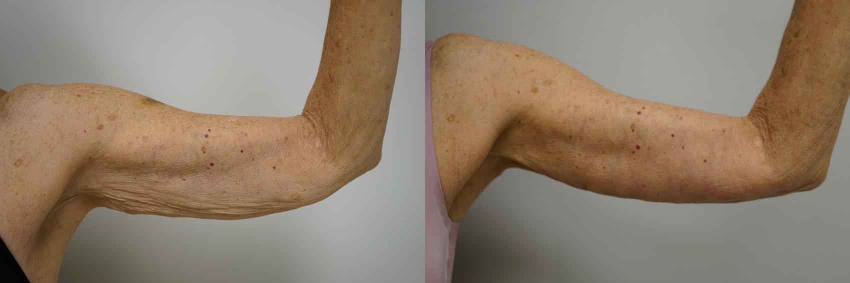 Before & After Brachioplasty Case 387 Right Side View in Gilbert, AZ