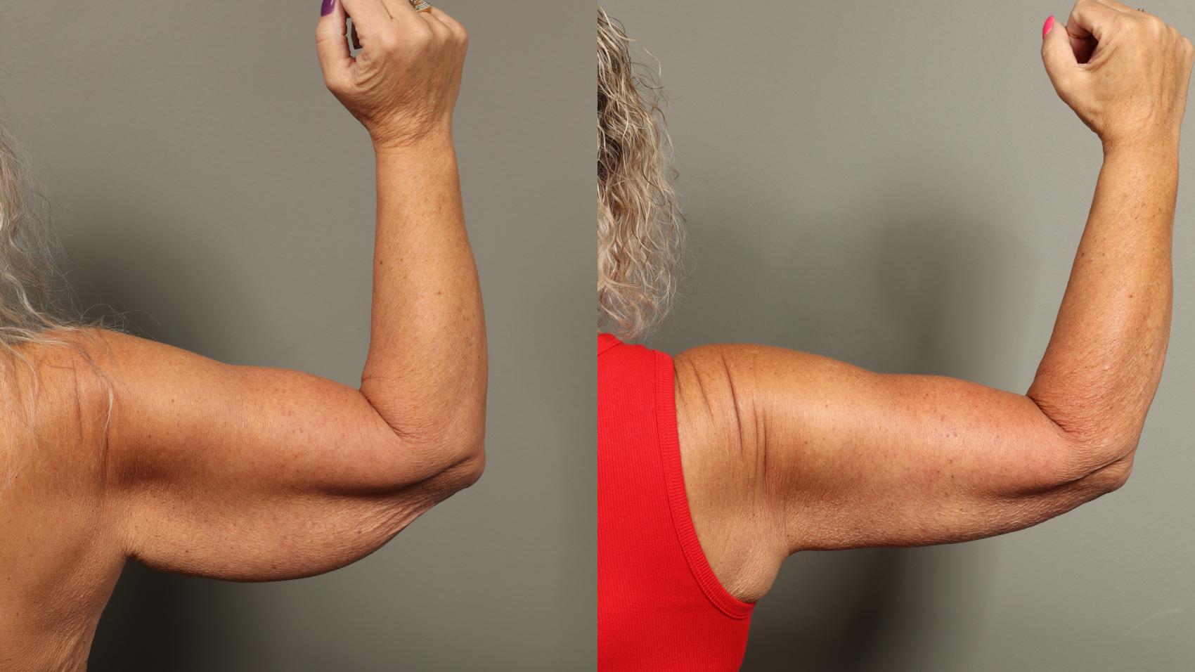 Before & After Brachioplasty Case 466 Back View in Gilbert, AZ