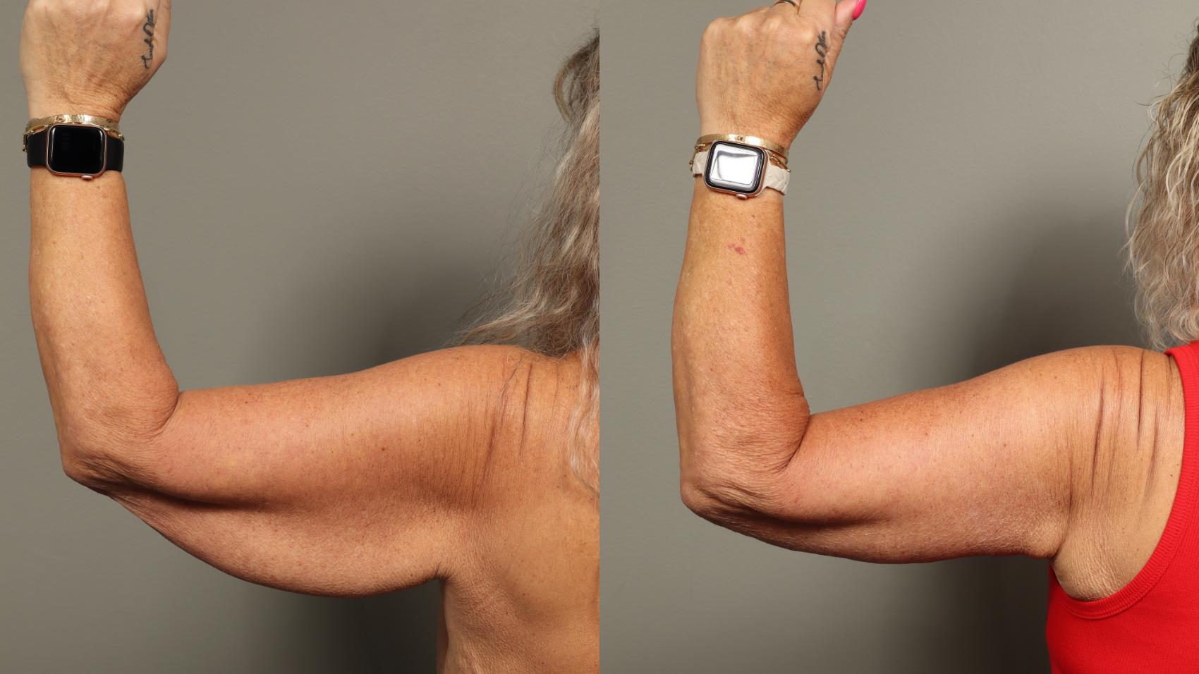Before & After Brachioplasty Case 466 Left Side View in Gilbert, AZ