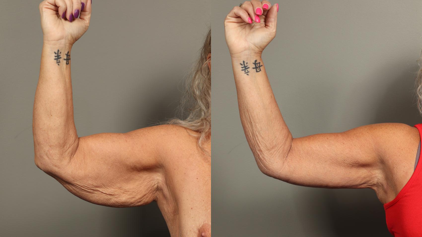 Before & After Brachioplasty Case 466 Right Side View in Gilbert, AZ