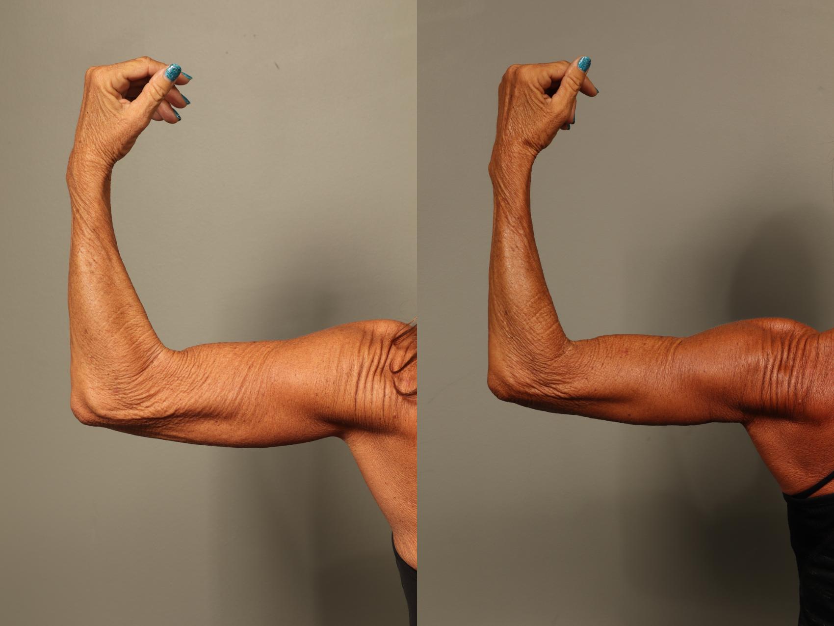 Before & After Brachioplasty Case 517 Front View in Gilbert, AZ