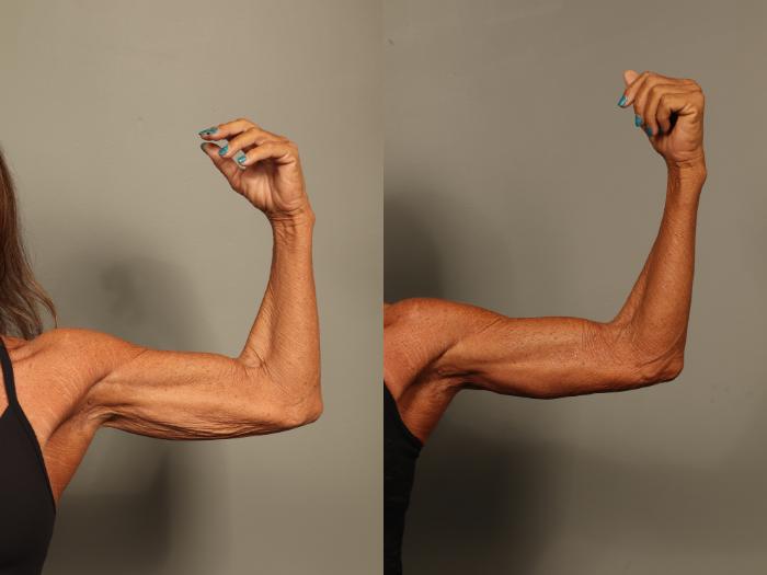 Before & After Brachioplasty Case 517 Left Oblique View in Gilbert, AZ