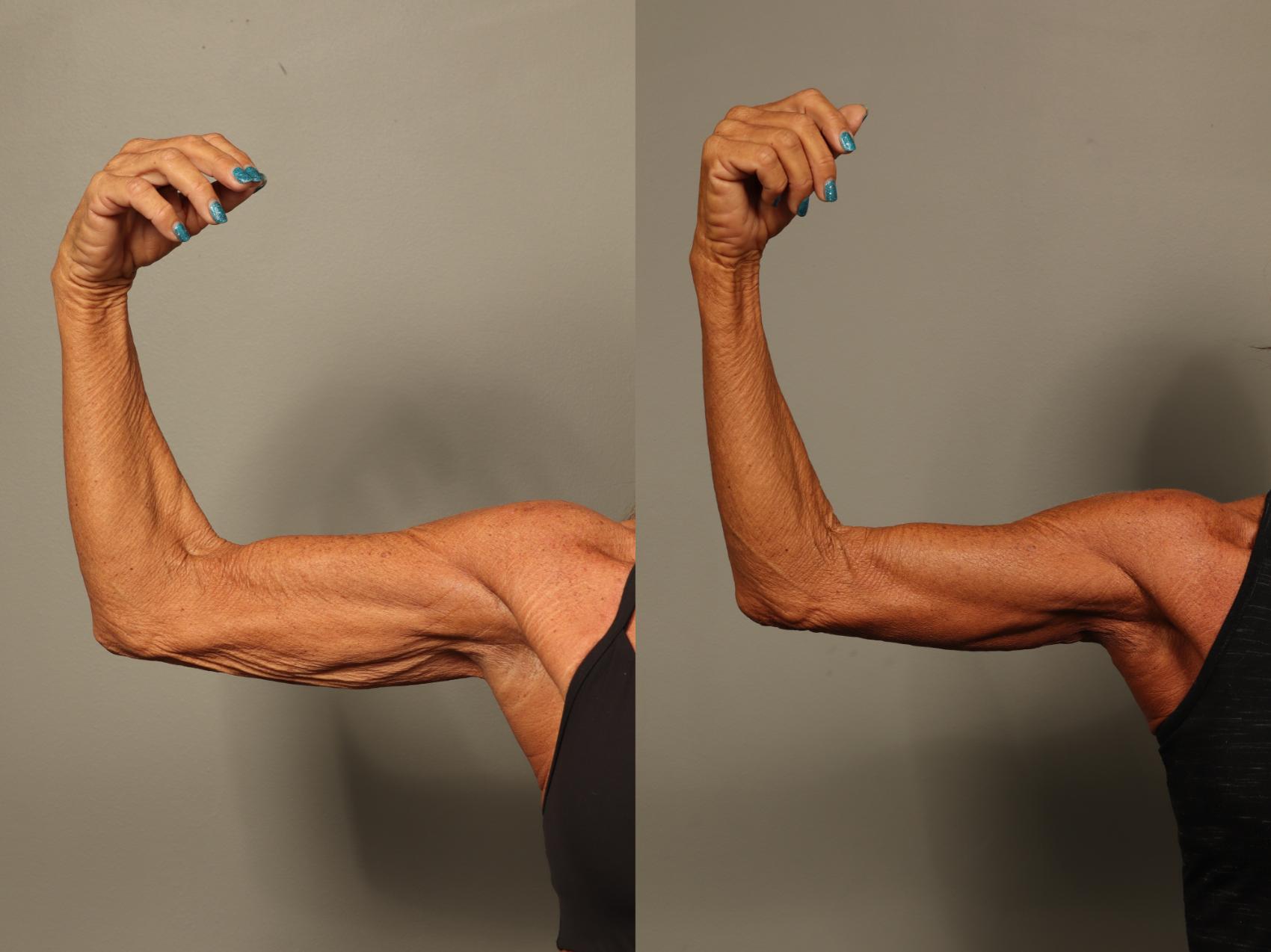 Before & After Brachioplasty Case 517 Left Side View in Gilbert, AZ