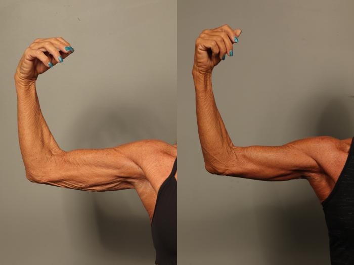 Before & After Brachioplasty Case 517 Left Side View in Gilbert, AZ