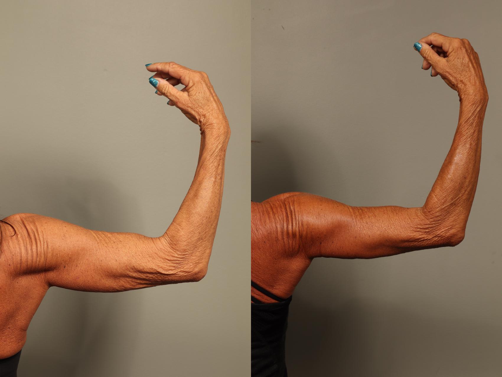 Before & After Brachioplasty Case 517 Right Side View in Gilbert, AZ