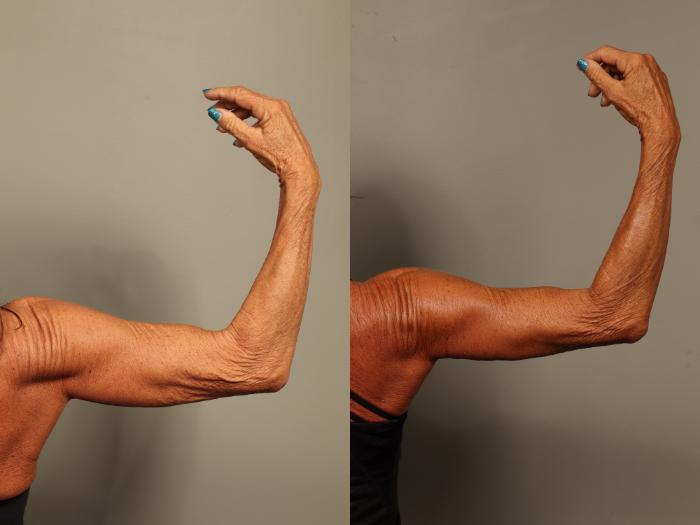 Before & After Brachioplasty Case 517 Right Side View in Gilbert, AZ