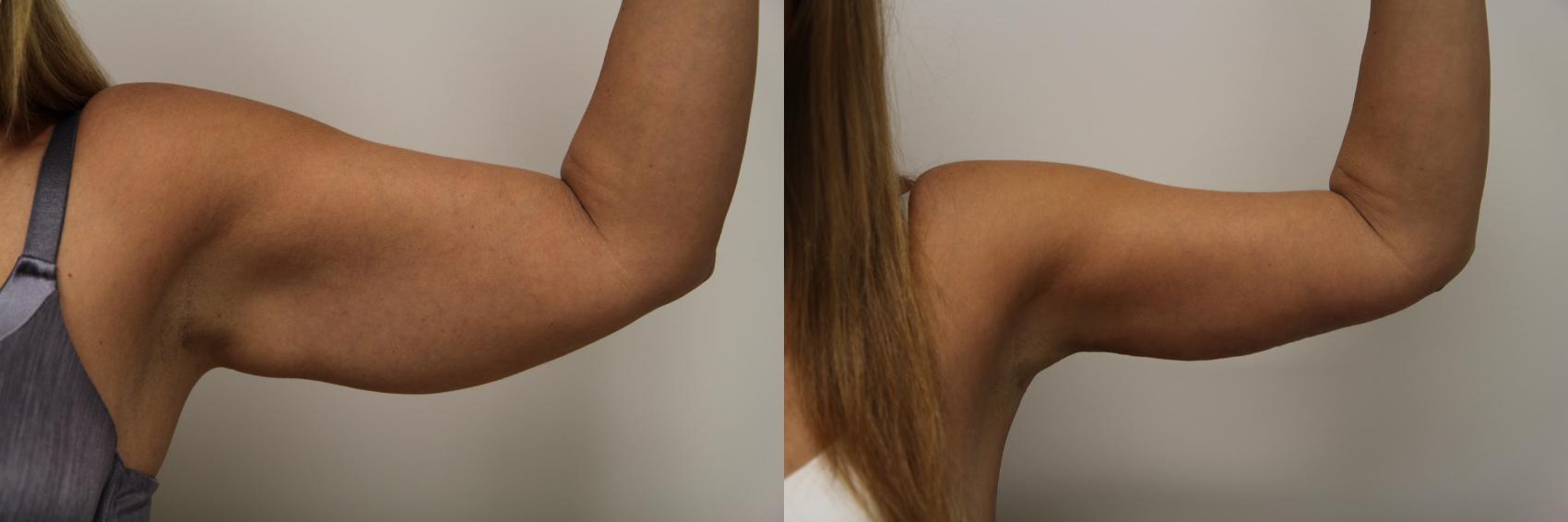 Before & After Brachioplasty Case 69 View #2 View in Gilbert, AZ