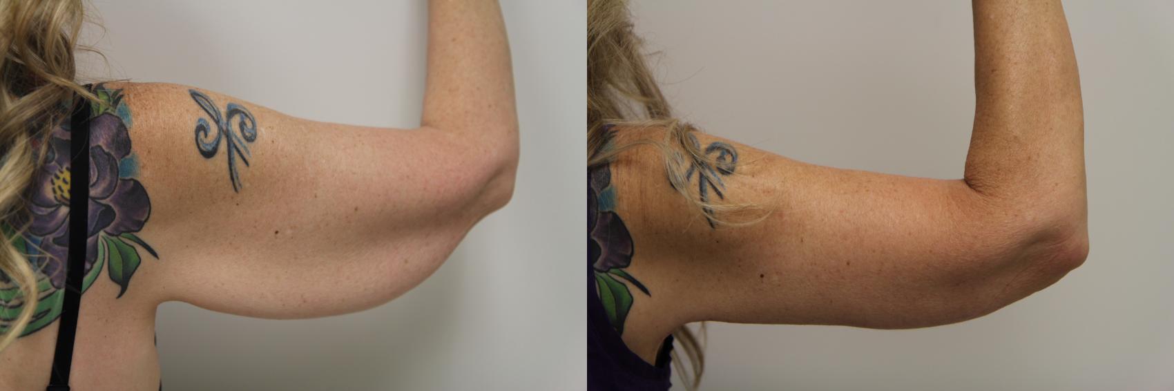 Before & After Brachioplasty Case 72 View #2 View in Gilbert, AZ