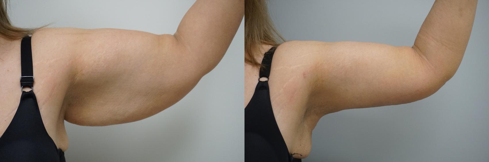 Before & After Brachioplasty Case 98 View #2 View in Gilbert, AZ